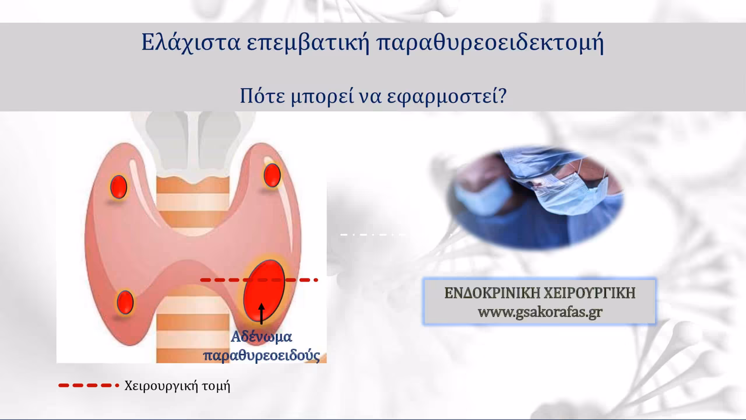 Παραθυρεοειδεκτομή – πότε έχει θέση η ελάχιστα επεμβατική παραθυρεοειδεκτομή στον πρωτοπαθή υπερπαραθυρεοειδισμό?