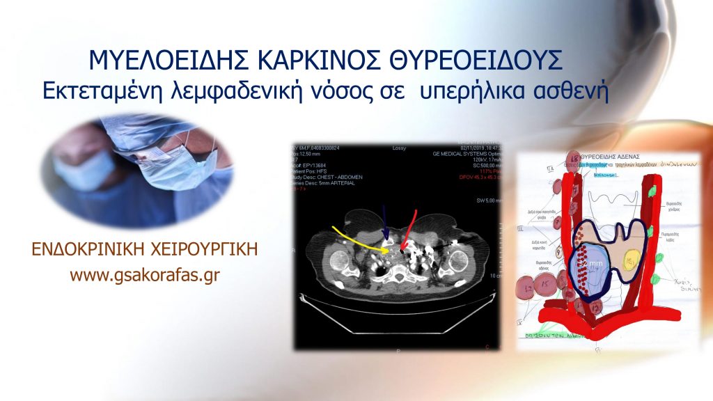 Μυελοειδής καρκίνος θυρεοειδούς σε υπερήλικα ασθενή με εκτεταμένες λεμφαδενικές μεταστάσεις