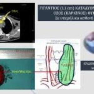 Γιγάντιος Καταδυόμενος Κακοήθης Όζος (Καρκίνος) Θυρεοειδούς Σε Υπερήλικα Ασθενή (85 Ετών)