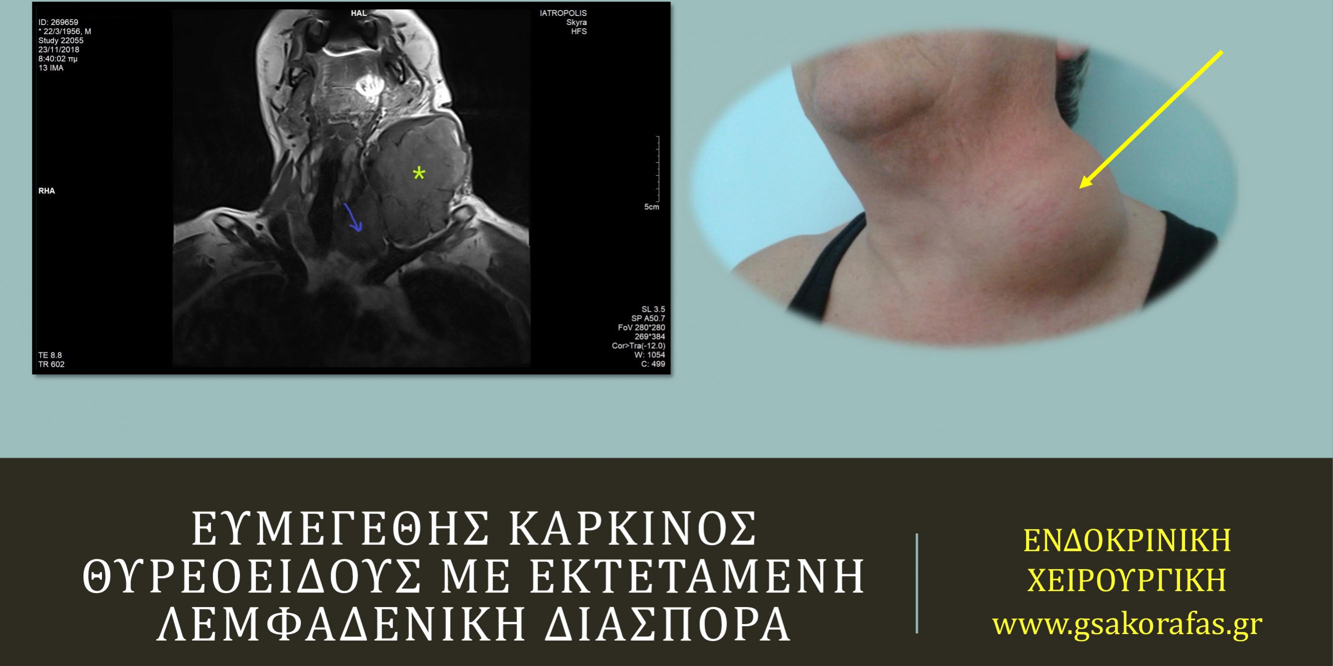 Ευμεγέθης θηλώδης καρκίνος θυρεοειδούς με εκτεταμένες λεμφαδενικές μεταστάσεις