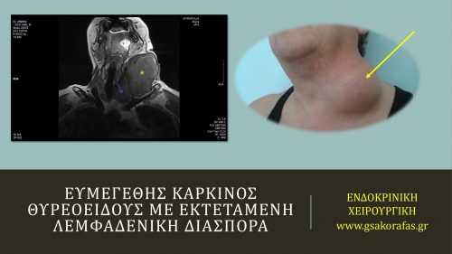 Ευμεγέθης θηλώδης καρκίνος θυρεοειδούς με εκτεταμένες λεμφαδενικές μεταστάσεις