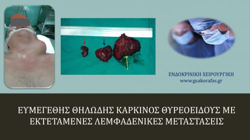 Θηλώδης καρκίνος θυρεοειδούς με εκτεταμένες λεμφαδενικές μεταστάσεις_2