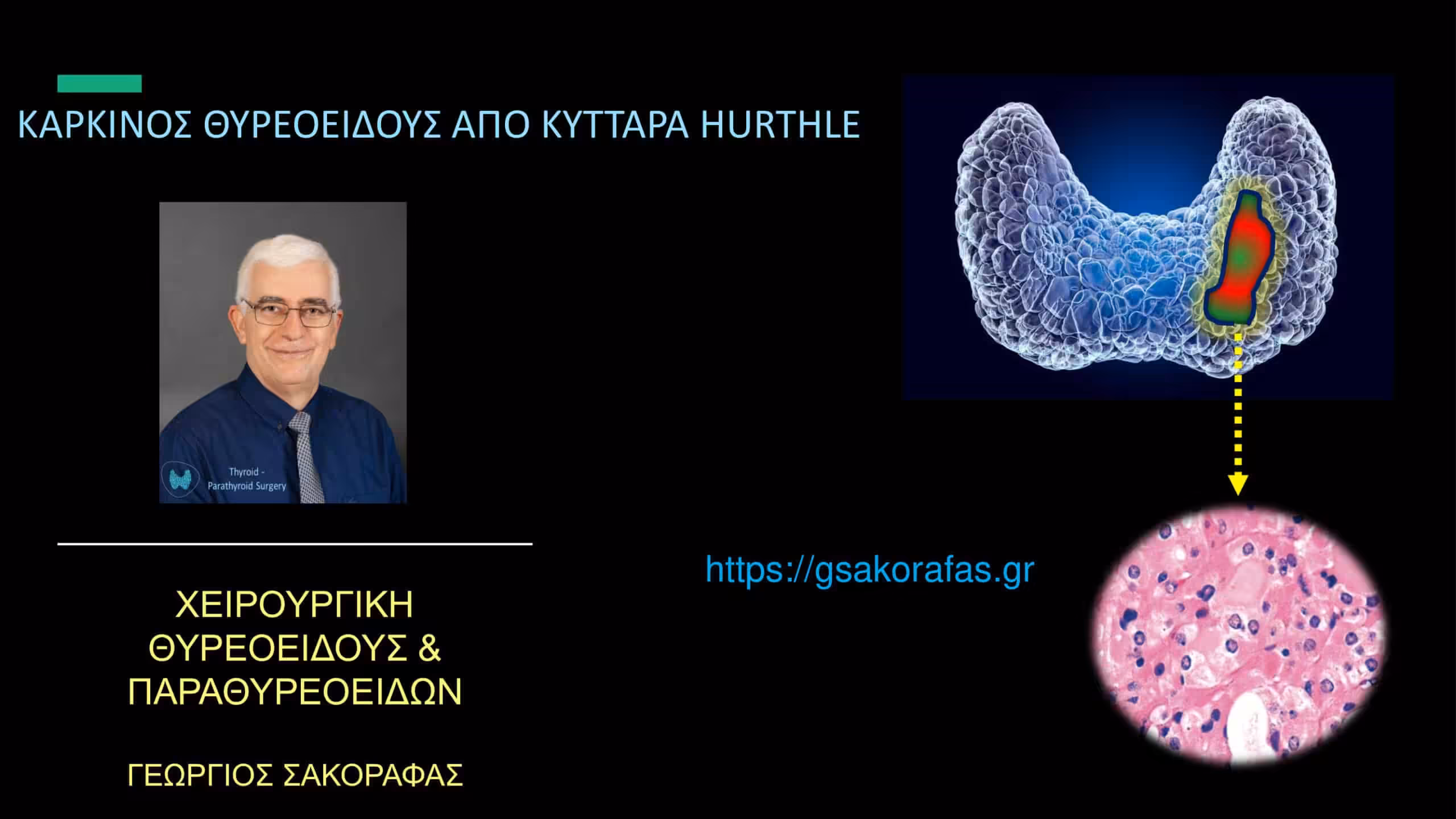 Καρκίνος θυρεοειδούς από κύτταρα Hürthle: τι είναι; γιατί αναφέρεται ξεχωριστά;