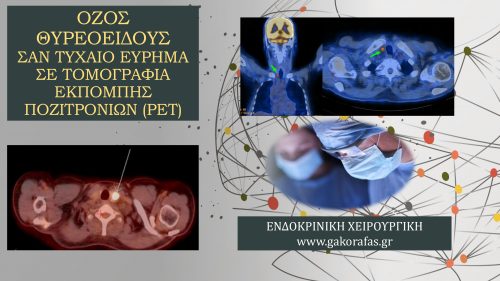 Όζος θυρεοειδούς σαν τυχαίο εύρημα σε τομογραφία εκπομπής ποζιτρονίων