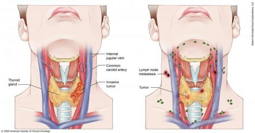 Μυελοειδές Καρκίνωμα Θυρεοειδούς-Οδοί Λεμφαδενικής Διασποράς Και Η Κλινική Τους Σημασία