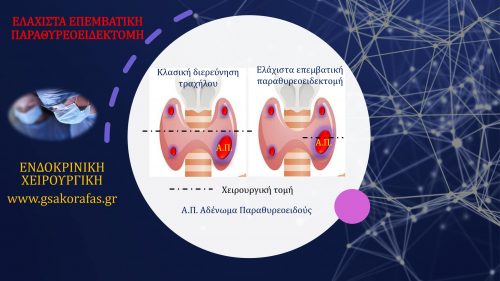 Αδένωμα παραθυρεοειδούς και ελάχιστα επεμβατική παραθυρεοειδεκτομή