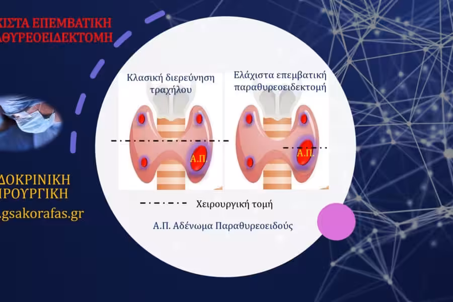 Αδένωμα παραθυρεοειδούς και ελάχιστα επεμβατική παραθυρεοειδεκτομή