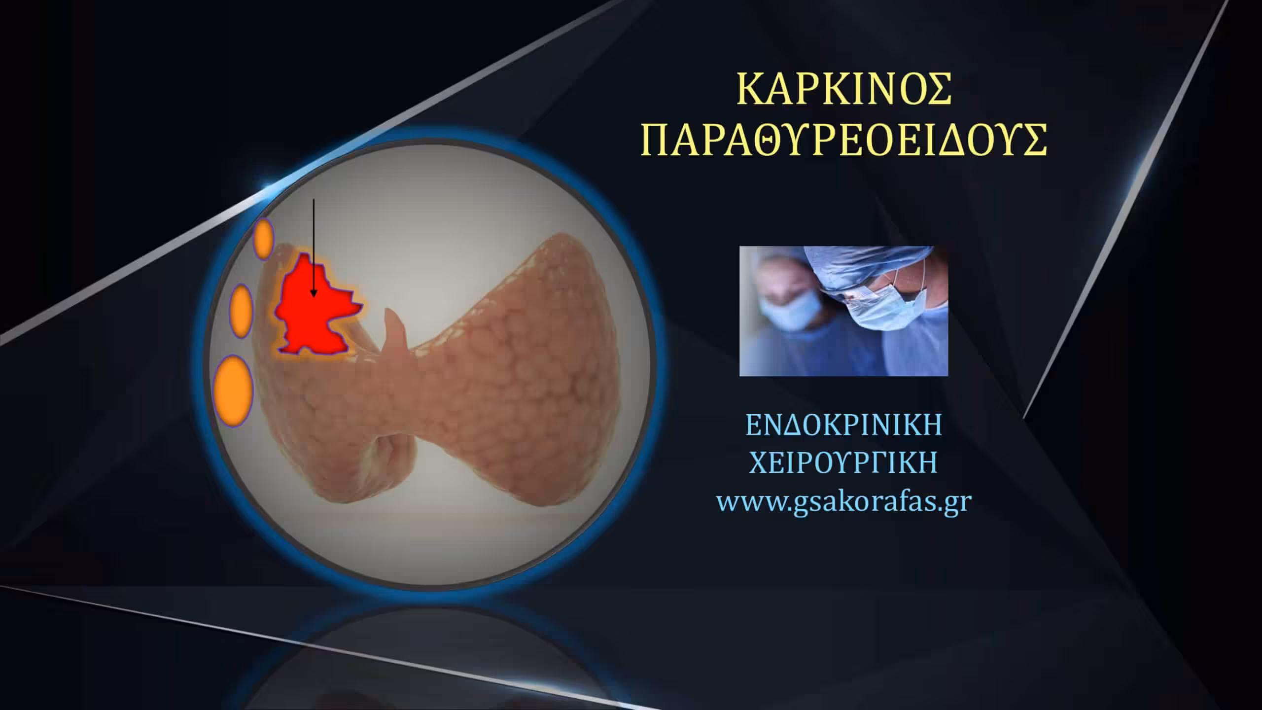 Καρκίνος παραθυρεοειδούς – προεγχειρητική διάγνωση και η σημασία της