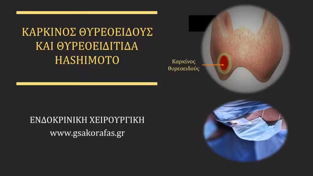 Θυρεοειδίτιδα Hashimoto Και Καρκίνος Θυρεοειδούς Καρκίνος Θυρεοειδούς Και Θυρεοειδίτιδα Hashimoto