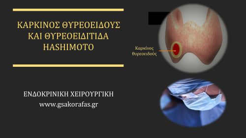 Καρκίνος Θυρεοειδούς Και Θυρεοειδίτιδα Hashimoto