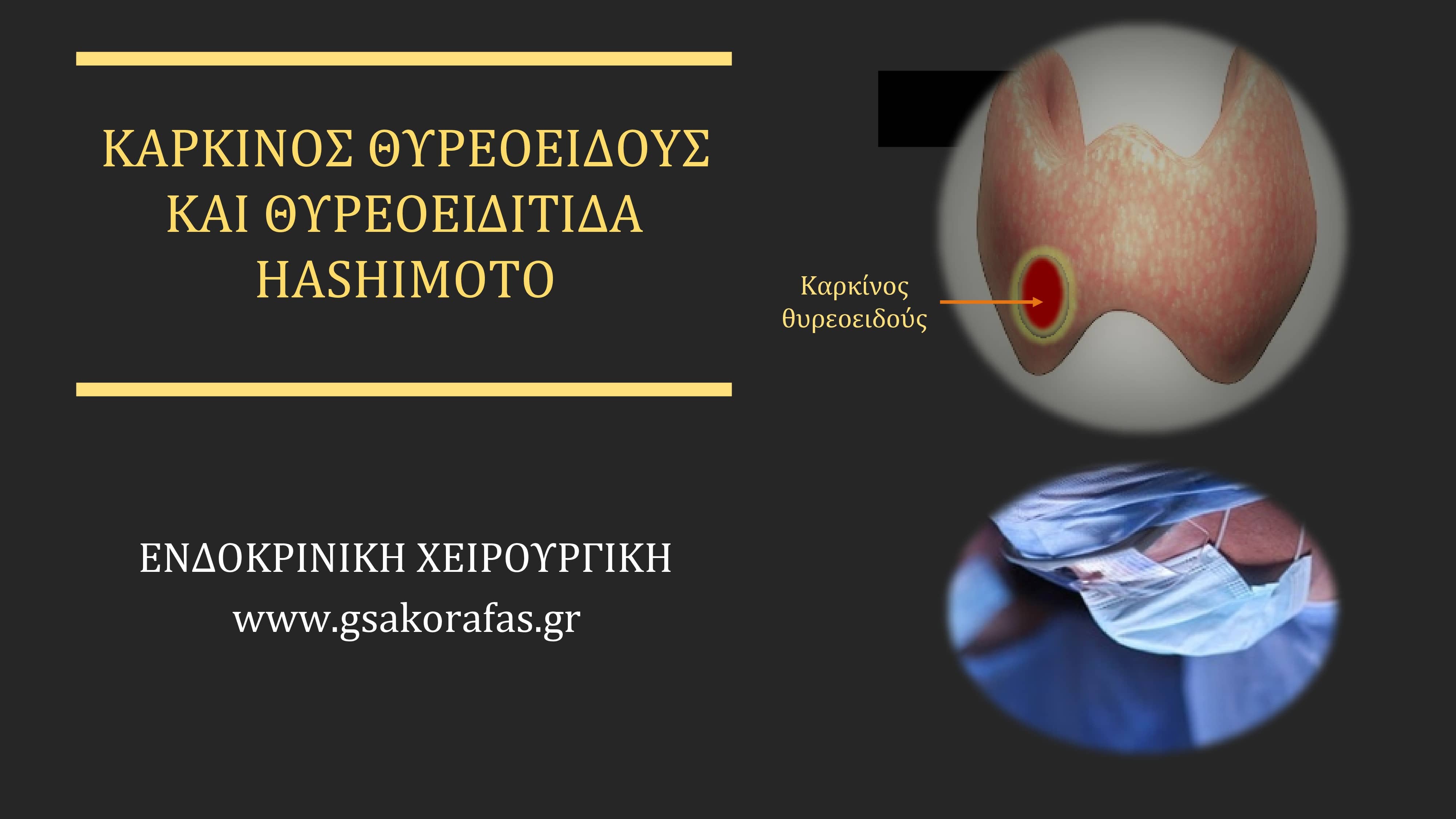 Θυρεοειδίτιδα Hashimoto και καρκίνος θυρεοειδούς