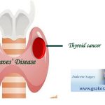 Καρκίνος θυρεοειδούς και Graves (νόσος)