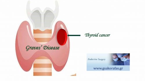 Καρκίνος Θυρεοειδούς Και Νόσος Graves - Επηρεάζει Ο Υπερθυρεοειδισμός Τη Βιολογική Συμπεριφορά Του Καρκίνου;