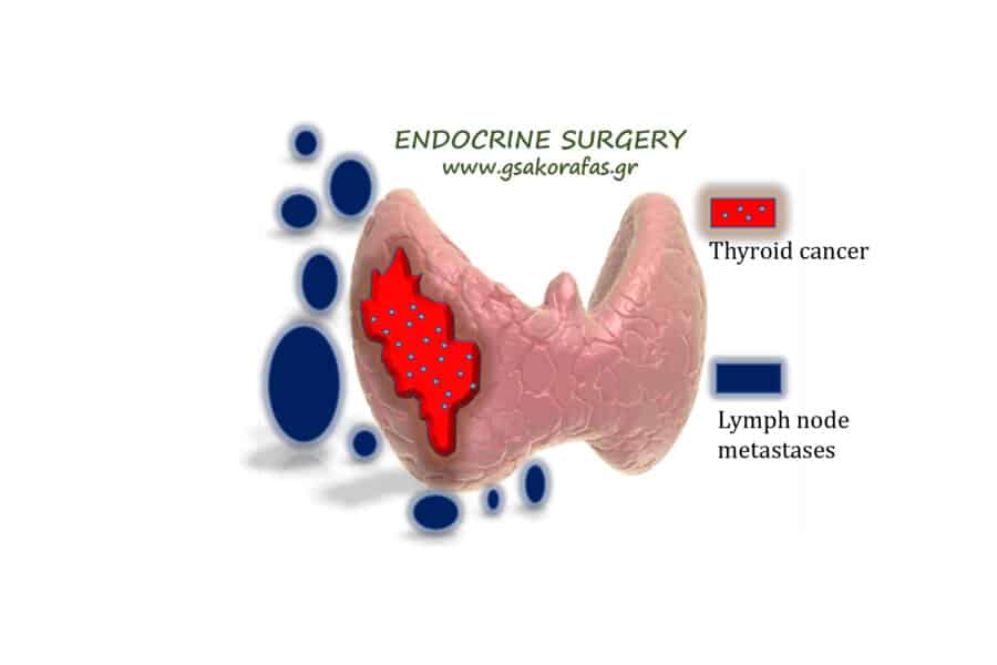 Καρκίνος θυρεοειδούς - λεμφαδενικές μεταστάσεις και κίνδυνος υποτροπής