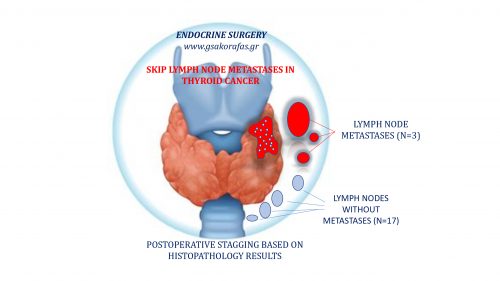 Καρκίνος θυρεοειδούς με ασυνεχείς λεμφαδενικές μεταστάσεις (skip lymph node metastases) σε ασθενή μας - σημασία στην πράξη