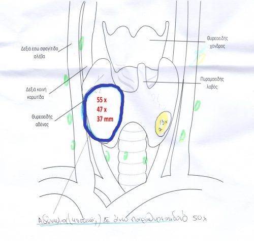 Εξαιρετικά ευμέγεθες (διάμετρος 55 mm!) αδένωμα παραθυρεοειδούς σε ηλικιωμένη ασθενή με πρωτοπαθή υπερπαραθυρεοειδισμό