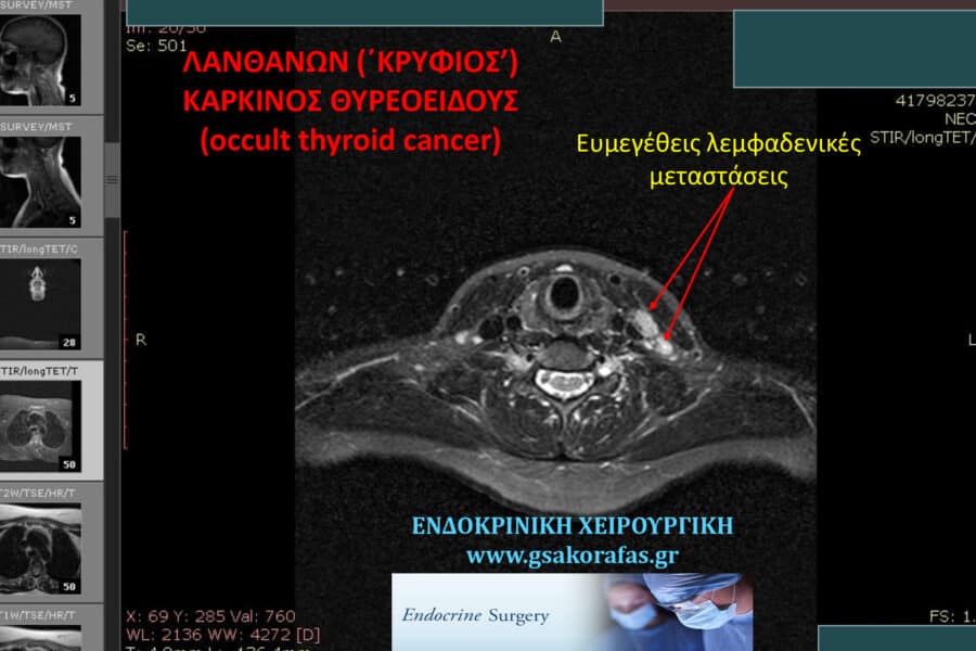 Λανθάνων (κρύφιος) καρκίνος θυρεοειδούς (occult thyroid cancer)