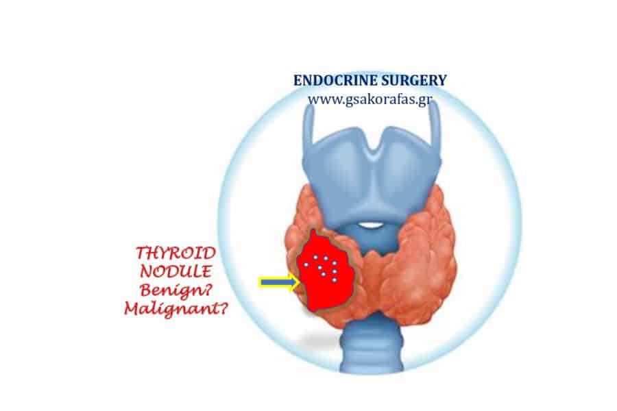 Όζοι θυρεοειδούς - πότε μπορεί να υποκρύπτεται καρκίνος θυρεοειδούς?