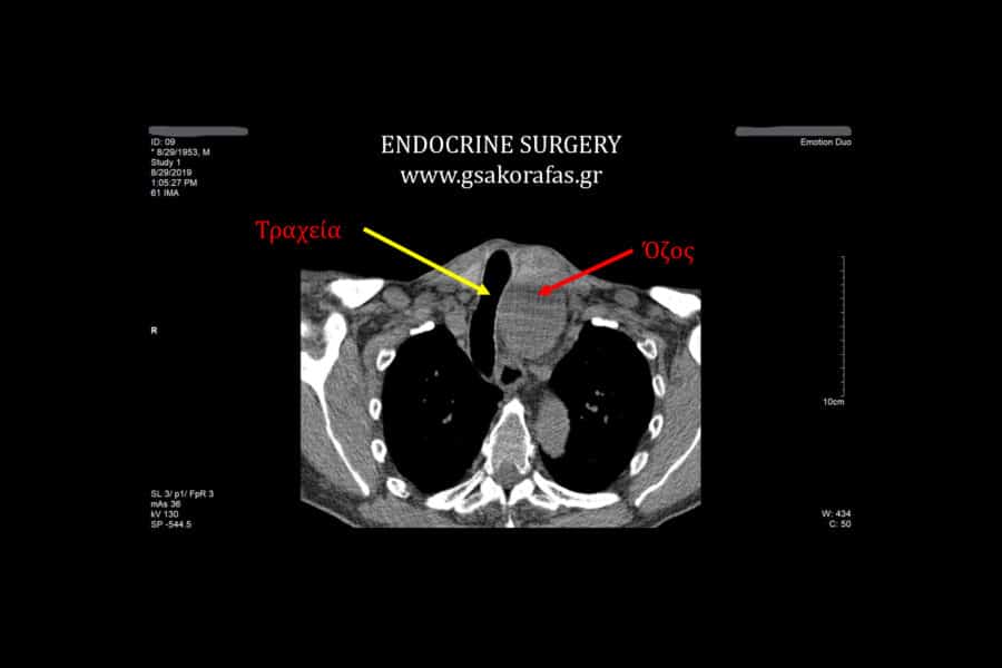 Ευμεγέθης καταδυόμενος όζος θυρεοειδούς σε ασθενή με κύφωση-Θυρεοειδεκτομή: προβλήματα και τεχνικές δυσχέρειες_1