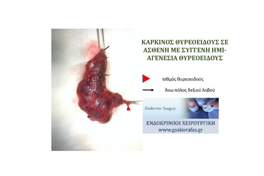 Συγγενής ημι-αγενεσία θυρεοειδούς και καρκίνος θυρεοειδούς - μία εξαιρετικά σπάνια περίπτωση ασθενούς
