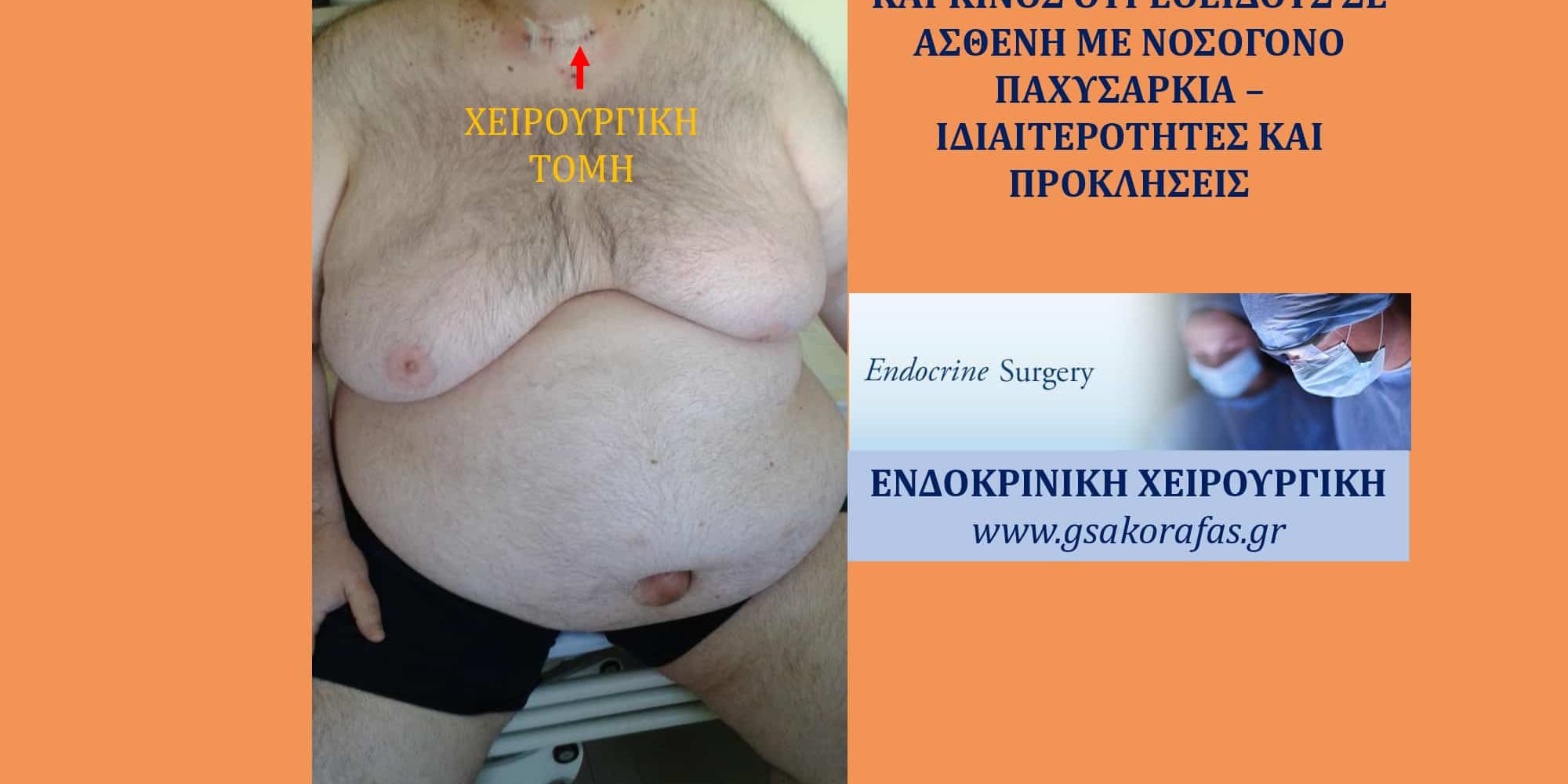 Καρκίνος θυρεοειδούς και νοσογόνος παχυσαρκία_1