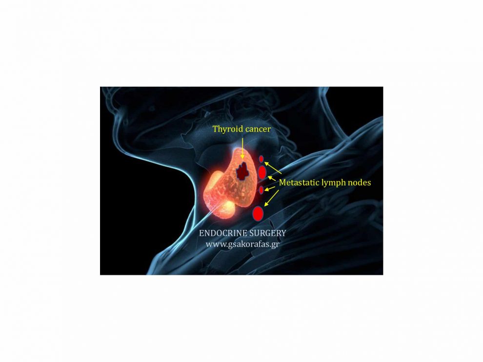 Καρκίνος θυρεοειδούς και χειρουργική επέμβαση (θυρεοειδεκτομή με ή χωρίς λεμφαδενικό καθαρισμό)-στόχοι της επέμβασης
