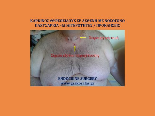 Καρκίνος θυρεοειδούς και νοσογόνος παχυσαρκία_2