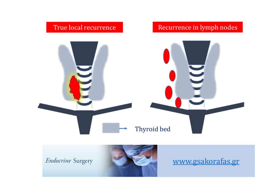 Καρκίνος θυρεοειδούς και υποτροπή στον τράχηλο