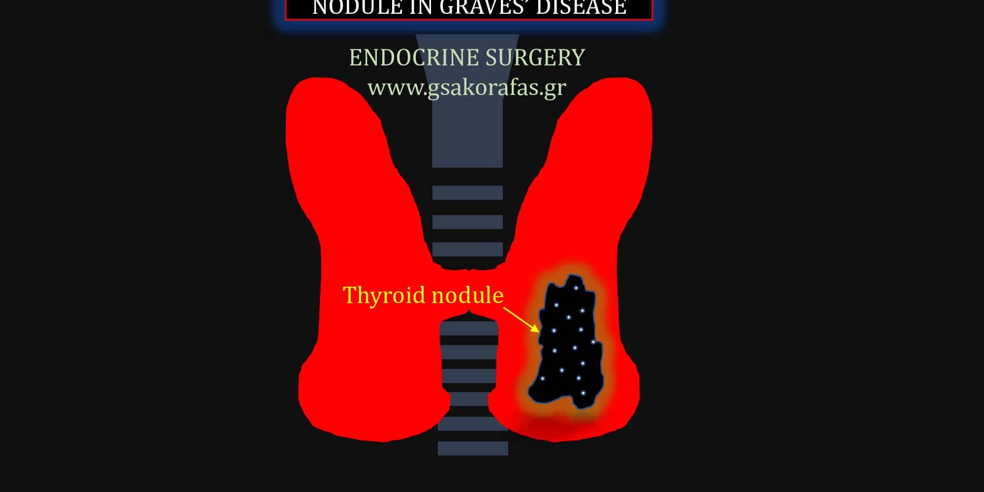 Όζος θυρεοειδούς και νόσος Graves (διάχυτη τοξική βρογχοκήλη)