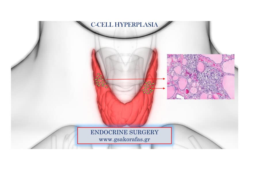 Υπερπλασία C-κυττάρων, πολυοζώδης βρογχοκήλη και οριακή αύξηση καλσιτονίνης ορού