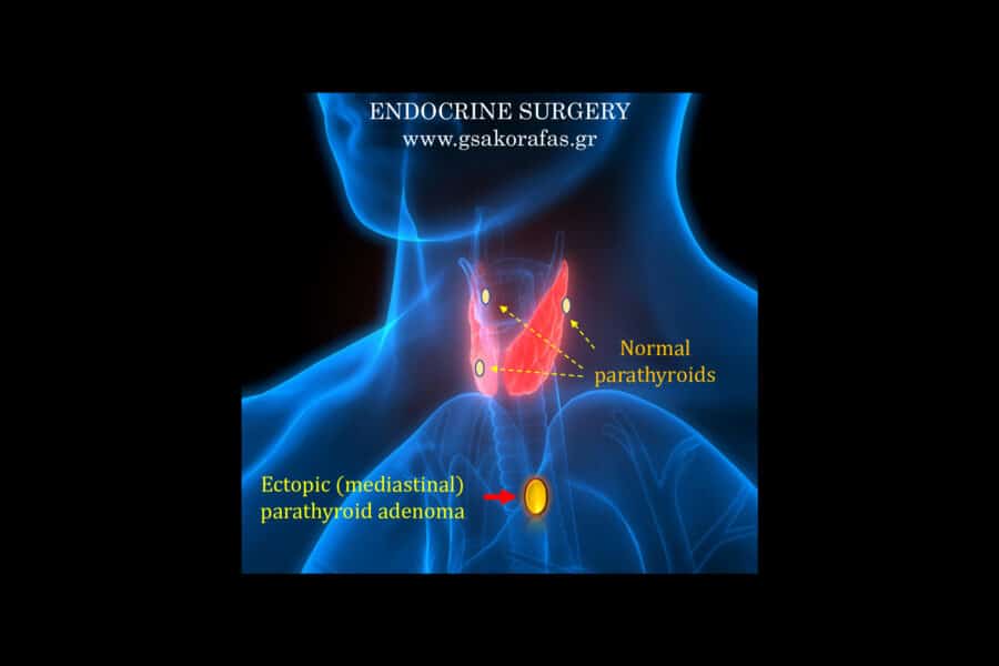 Έκτοπο αδένωμα παραθυρεοειδούς: εμβρυολογία, ανατομία και κλινική σημασία