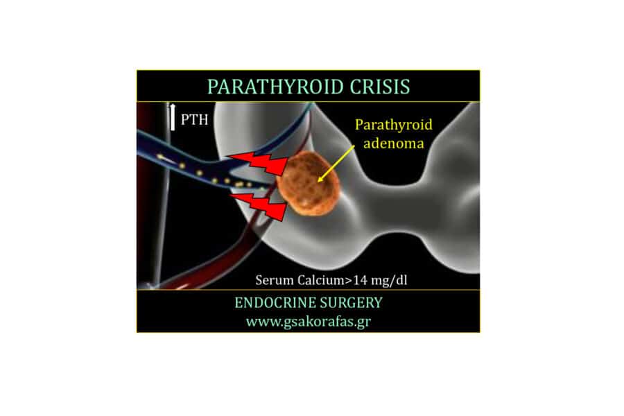 Υπερπαραθυρεοειδισμός και παραθυρεοειδική κρίση