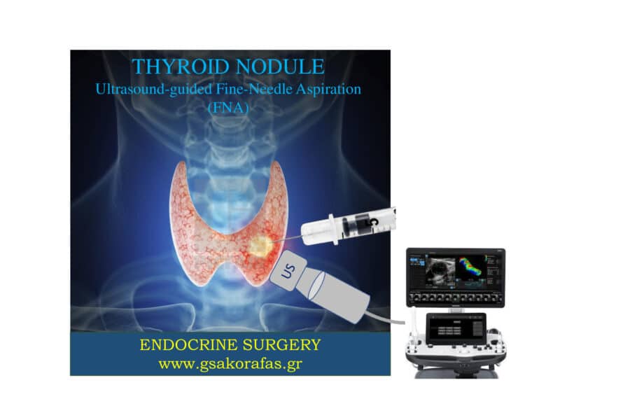 Όζος θυρεοειδούς και παρακέντηση - πότε θα πρέπει να γίνεται?