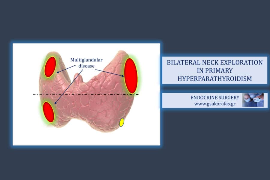 Υπερπαραθυρεοειδισμός, αμφοτερόπλευρη διερεύνηση τραχήλου και ελάχιστα επεμβατική παραθυρεοειδεκτομή