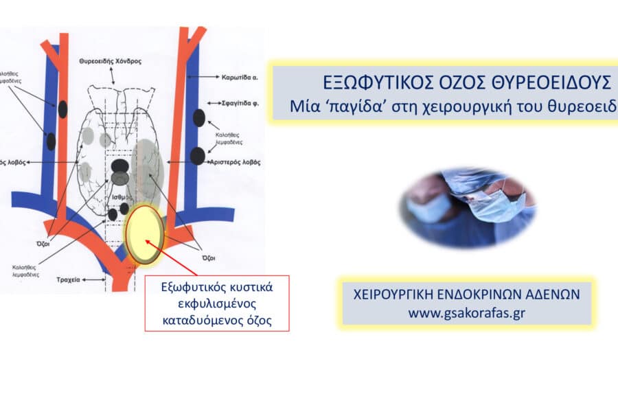 Εξωφυτικός όζος θυρεοειδούς