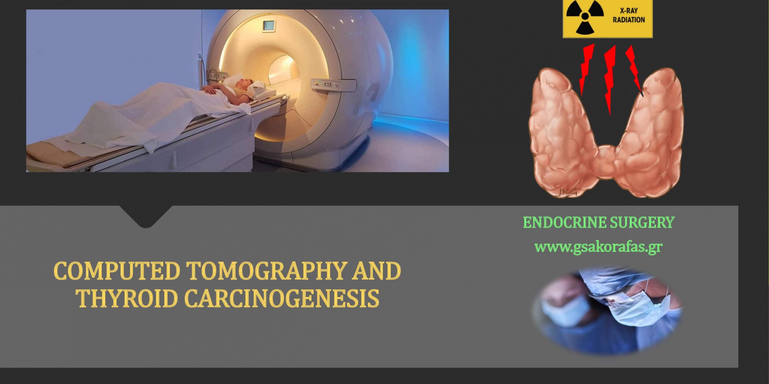 Computed Tomography and Thyroid Carcinogenesis