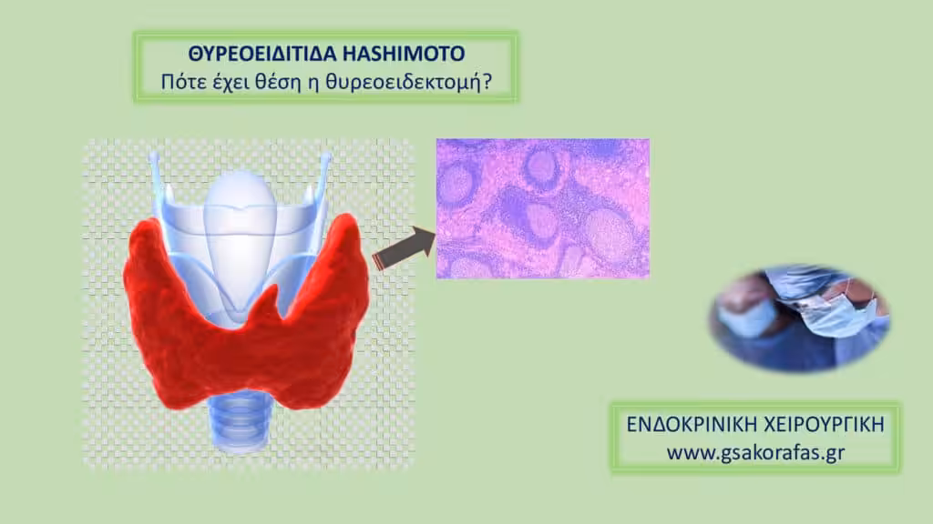 Θυρεοειδίτιδα Hashimoto-Πότε Έχει Θέση Η Θυρεοειδεκτομή; Θυρεοειδίτιδα Hashimoto-Πότε Έχει Θέση Η Θυρεοειδεκτομή