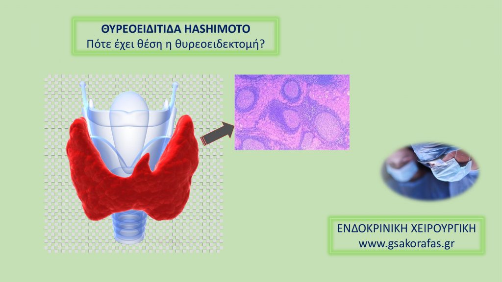 Θυρεοειδίτιδα Hashimoto-πότε έχει θέση η θυρεοειδεκτομή