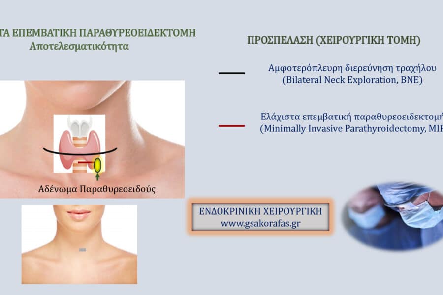 Πρωτοπαθής Υπερπαραθυρεοειδισμός και ελάχιστα επεμβατική παραθυρεοειδεκτομή - Αποτελεσματικότητα και Ασφάλεια