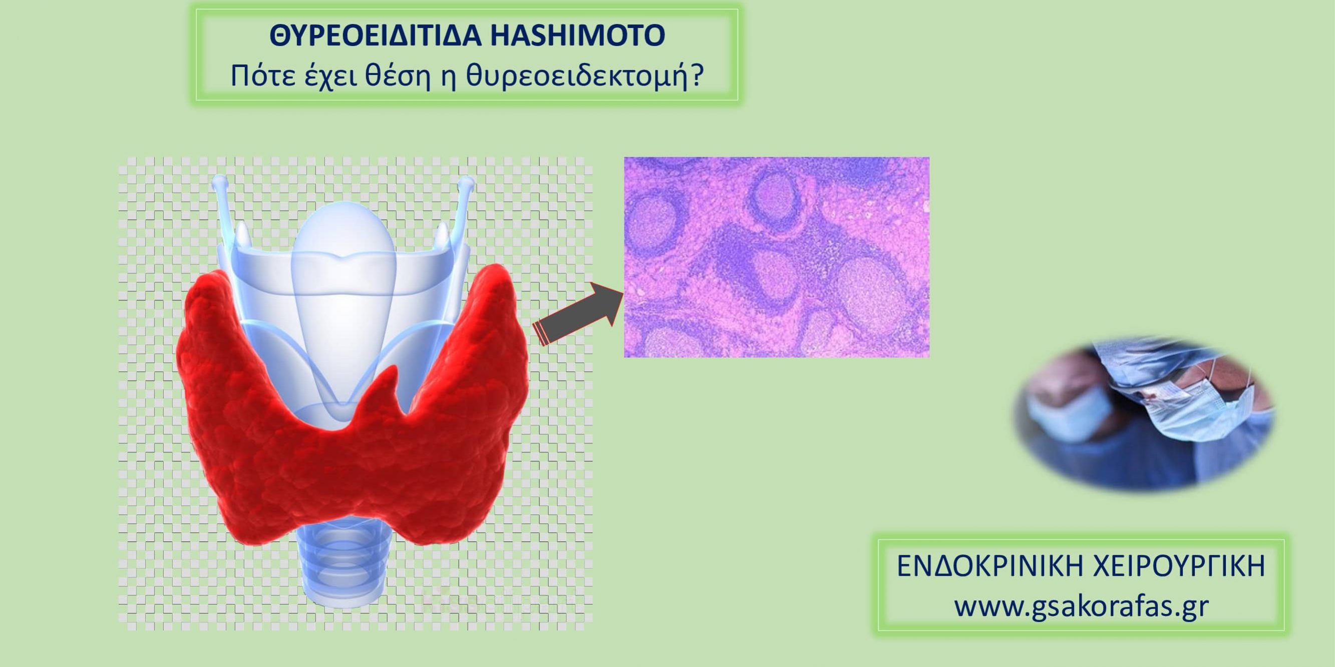 Θυρεοειδίτιδα Hashimoto-πότε έχει θέση η θυρεοειδεκτομή