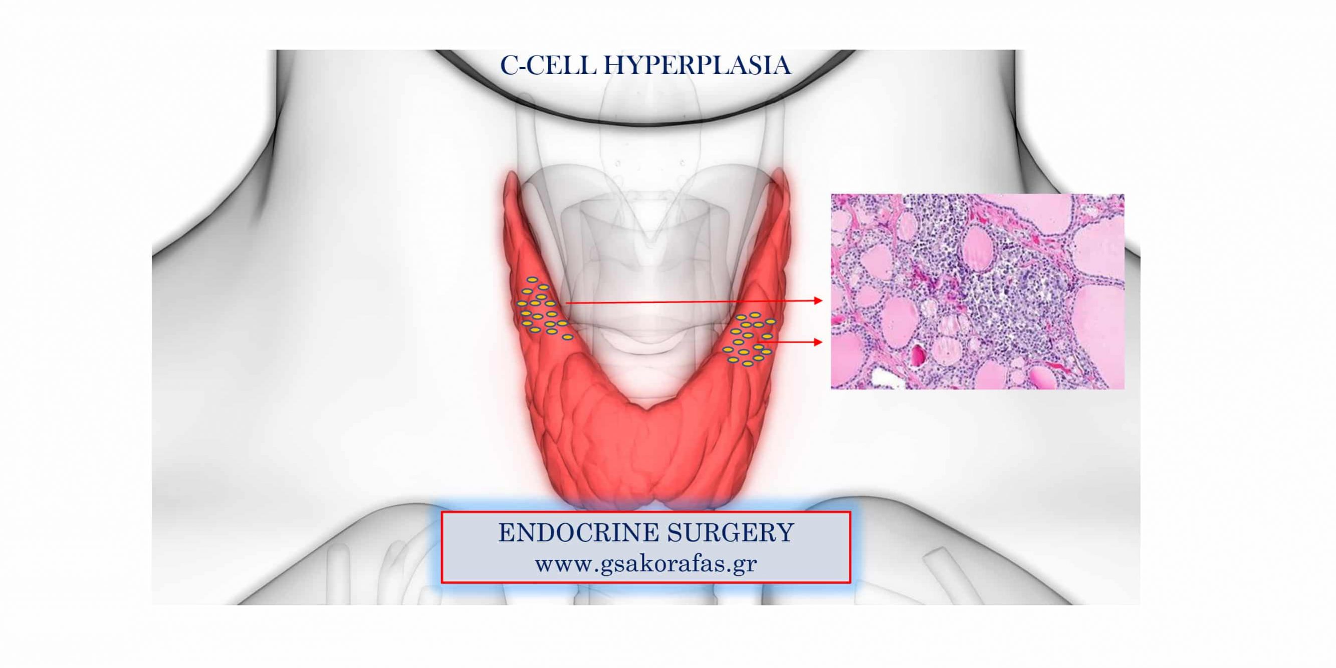 C-cell hyperplasia as an incidental finding following thyroidectomy - practical significance
