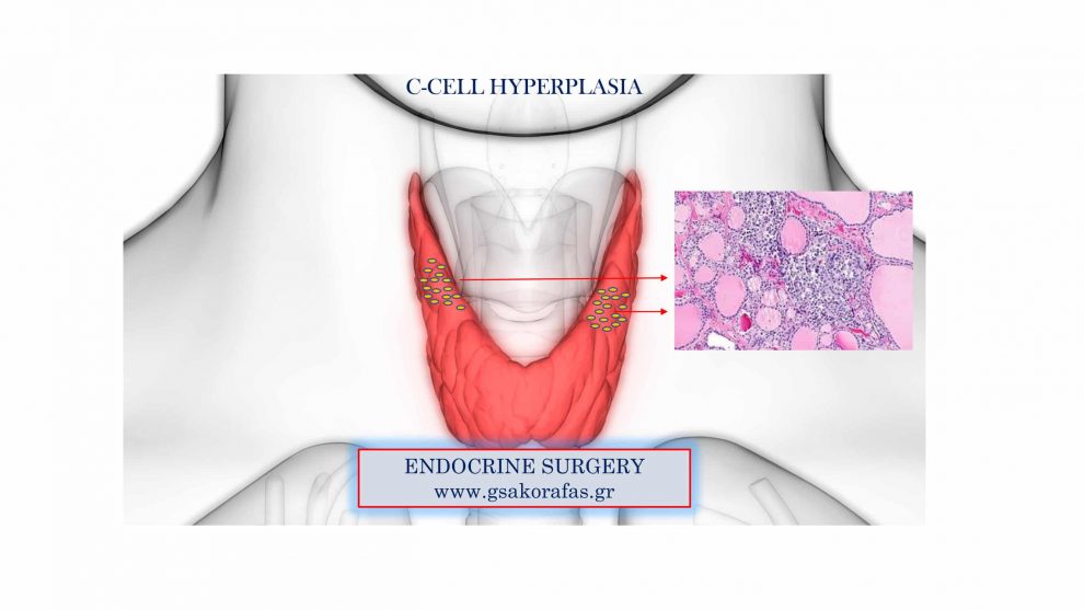 C-cell hyperplasia as an incidental finding following thyroidectomy - practical significance