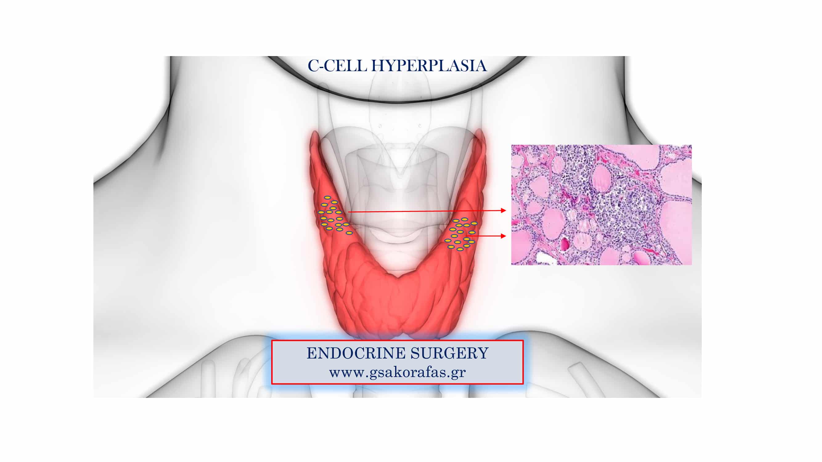 C-cell hyperplasia as an incidental finding following thyroidectomy – practical significance