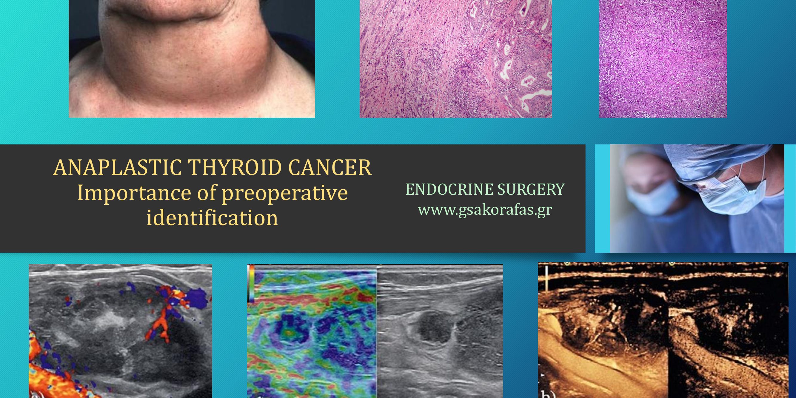 Anaplastic Thyroid Cancer Importance Of Preoperative Diagnosis