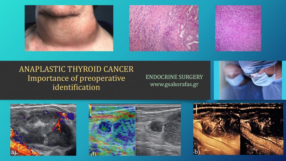 Anaplastic thyroid cancer - importance of preoperative diagnosis