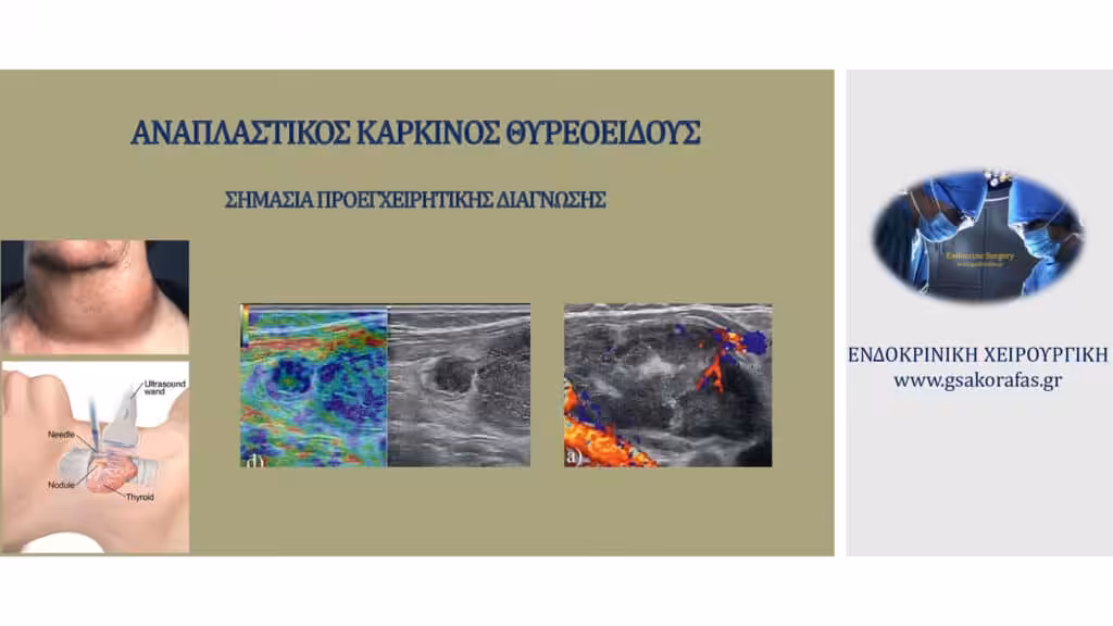 Αναπλαστικός Καρκίνος Θυρεοειδούς Και Προεγχειρητική Διάγνωση - Πρακτική Σημασία Αναπλαστικός Καρκίνος Θυρεοειδούς Και Προεγχειρητική Διάγνωση - Πρακτική Σημασία