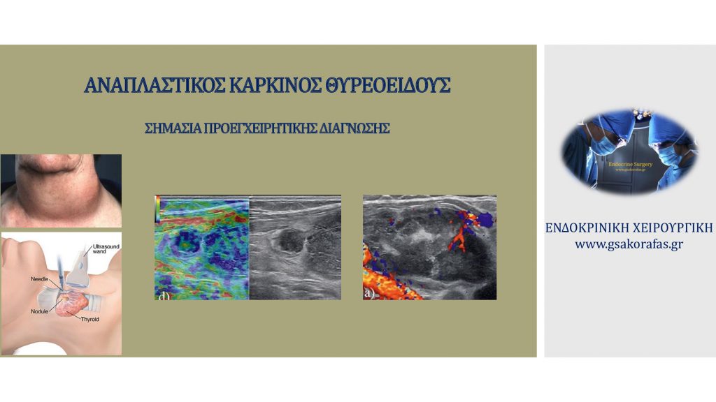 Αναπλαστικός καρκίνος θυρεοειδούς και προεγχειρητική διάγνωση - πρακτική σημασία