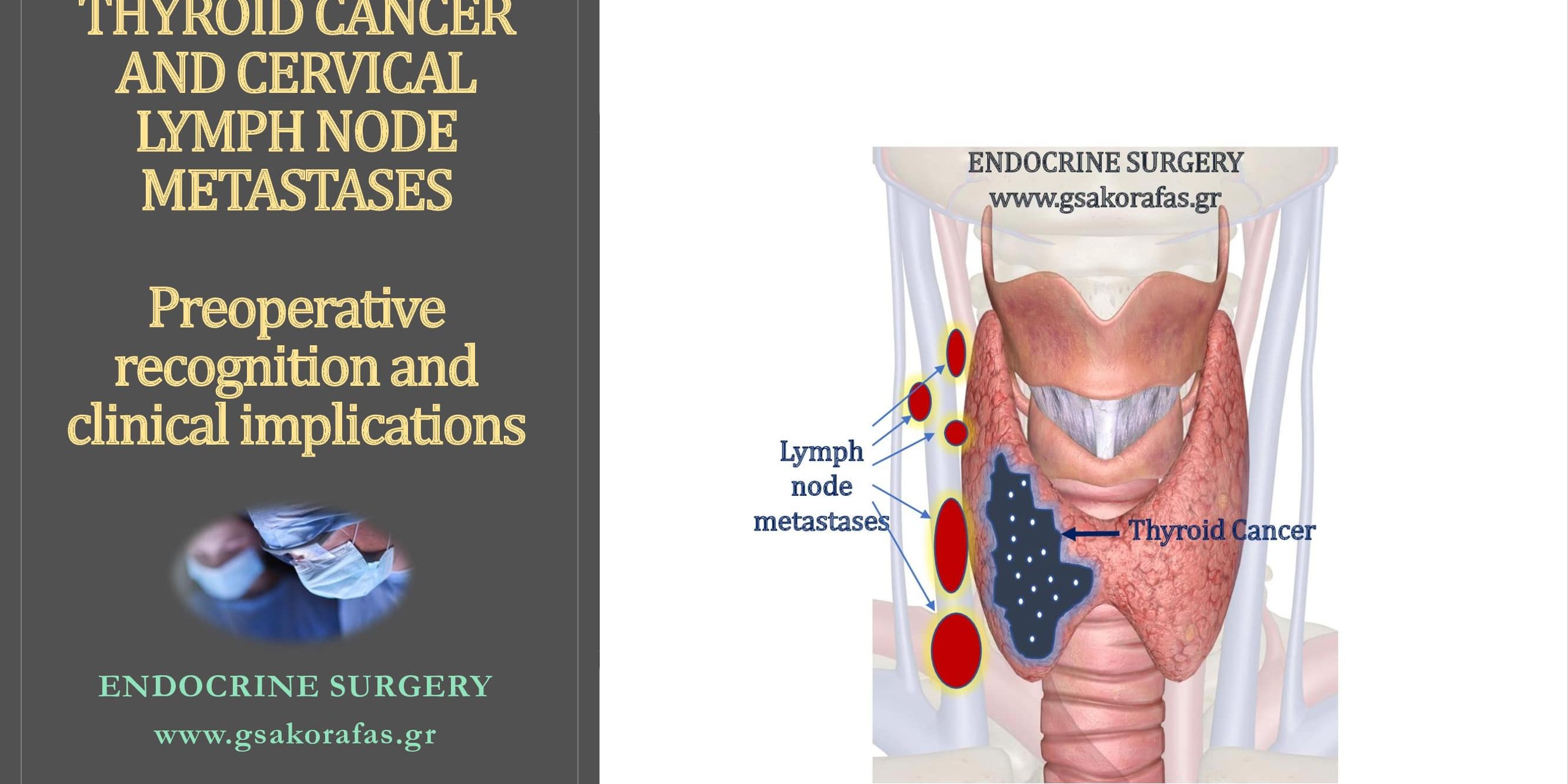 thyroid-cancer-and-cervical-lymph-nodes