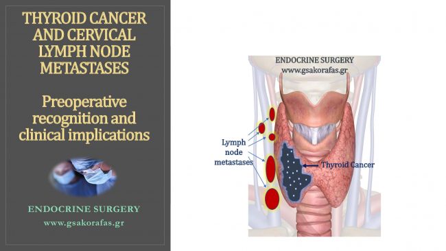 Thyroid cancer and lymph node metastases - Importance of preoperative diagnosis