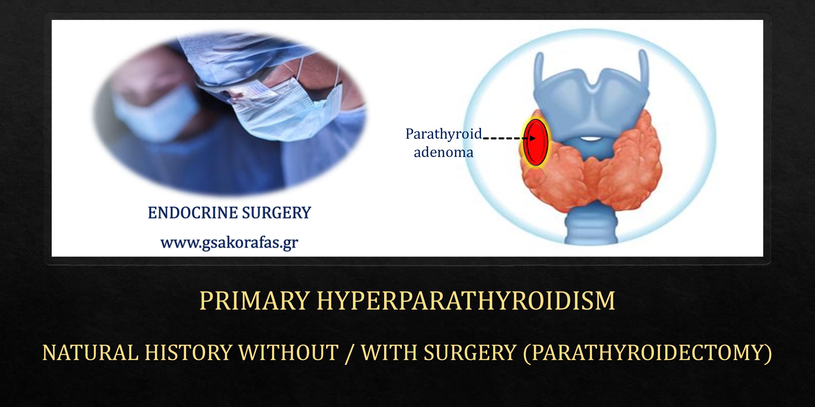 Hyperparathyroidism Parathyroidectomy And Natural History Of The Disease